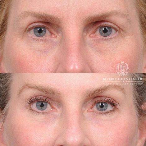 Beverly Hills Center Male Patient Before and After AuraLyft, Brow Lift with TCA Peel and Lip Lift