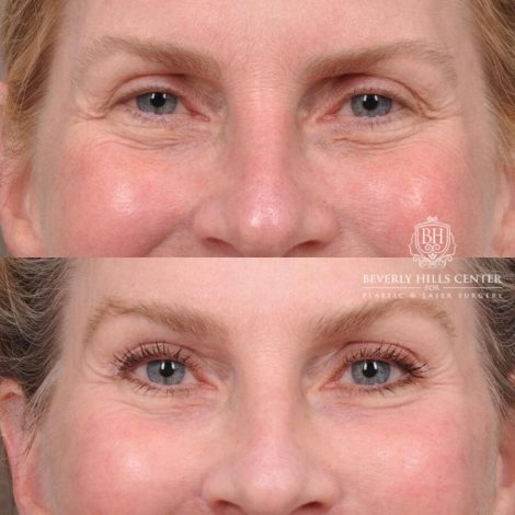 Beverly Hills Center Male Patient Before and After AuraLyft, Brow Lift with TCA Peel and Lip Lift