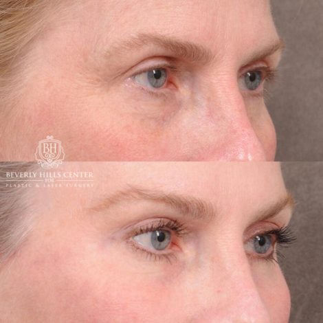 Beverly Hills Center Male Patient Before and After AuraLyft, Brow Lift with TCA Peel and Lip Lift