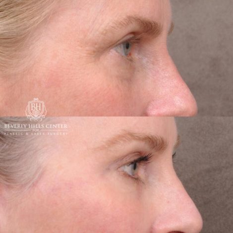 Beverly Hills Center Male Patient Before and After AuraLyft, Brow Lift with TCA Peel and Lip Lift