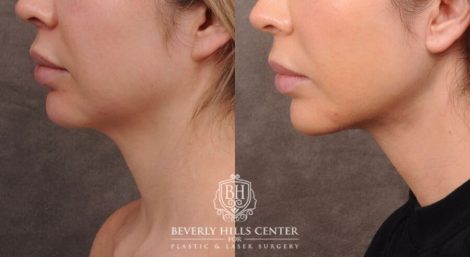 Beverly Hills Center Female Patient Before and After Weekend Necklift, Profound, Platysmaplasty