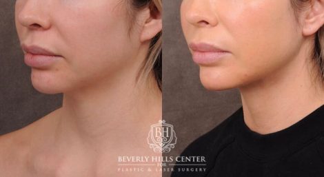 Beverly Hills Center Female Patient Before and After Weekend Necklift, Profound, Platysmaplasty