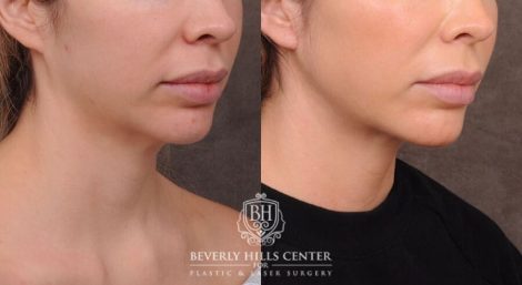 Beverly Hills Center Female Patient Before and After Weekend Necklift, Profound, Platysmaplasty