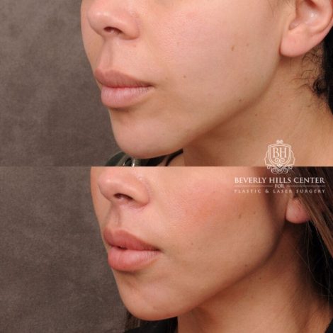 Beverly Hills Center Female Patient Before and After CUPID LIFT® Lip Lift