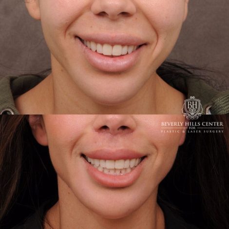 Beverly Hills Center Female Patient Before and After CUPID LIFT® Lip Lift