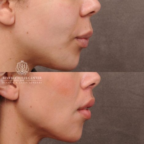 Beverly Hills Center Female Patient Before and After CUPID LIFT® Lip Lift