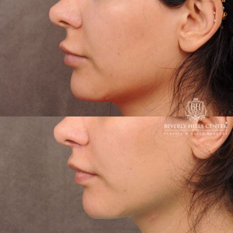 Beverly Hills Center Female Patient Before and After CUPID LIFT® Lip Lift