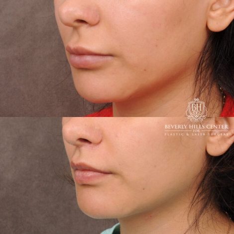 Beverly Hills Center Female Patient Before and After CUPID LIFT® Lip Lift