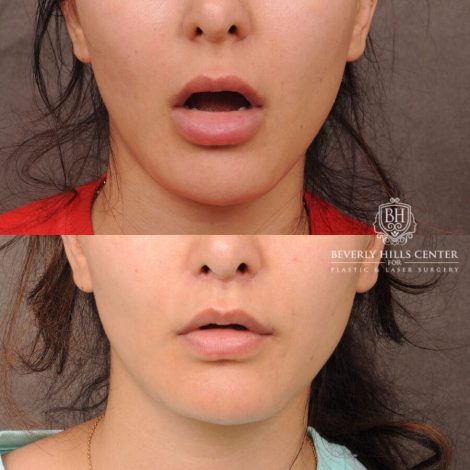 Beverly Hills Center Female Patient Before and After CUPID LIFT® Lip Lift