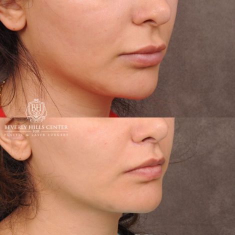 Beverly Hills Center Female Patient Before and After CUPID LIFT® Lip Lift