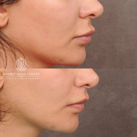Beverly Hills Center Female Patient Before and After CUPID LIFT® Lip Lift