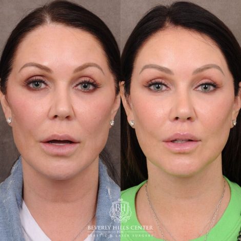 Beverly Hills Center Female Patient Before and After Deep Plane Upper Lip Lift, CUPID LIFT® Corner Lift, AuraLyft, TCA Peel (Eyes), Lateral Brow Lift