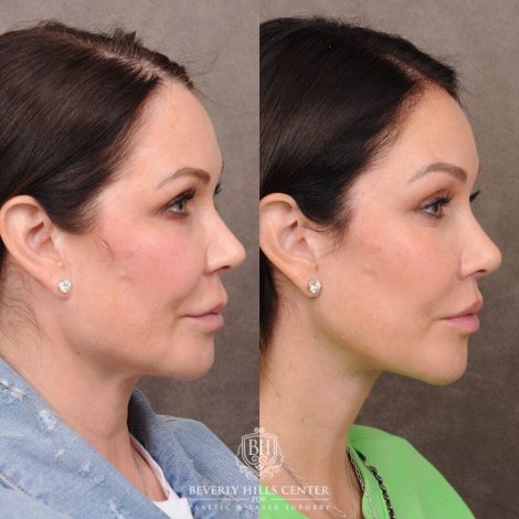 Beverly Hills Center Female Patient Before and After Deep Plane Upper Lip Lift, CUPID LIFT® Corner Lift, AuraLyft, TCA Peel (Eyes), Lateral Brow Lift