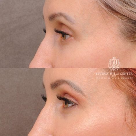 Beverly Hills Center Female Patient Before and After Upper Blepharoplasty