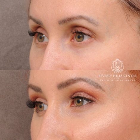 Beverly Hills Center Female Patient Before and After Upper Blepharoplasty