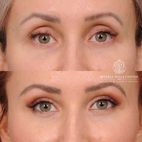 Beverly Hills Center Female Patient Before and After Upper Blepharoplasty