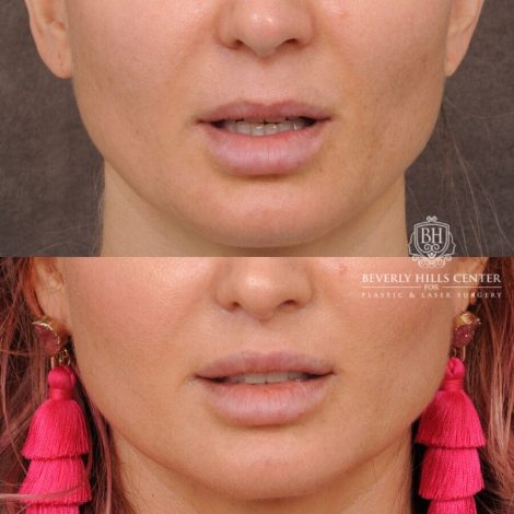 Beverly Hills Center Female Patient Before and After CUPID LIFT®