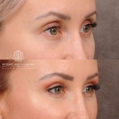 Beverly Hills Center Female Patient Before and After Upper Blepharoplasty