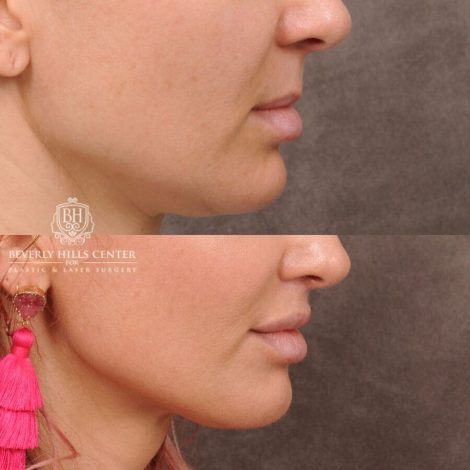 Beverly Hills Center Female Patient Before and After CUPID LIFT®