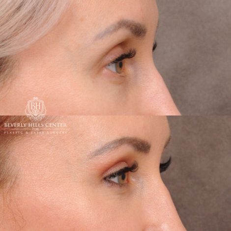 Beverly Hills Center Female Patient Before and After Upper Blepharoplasty
