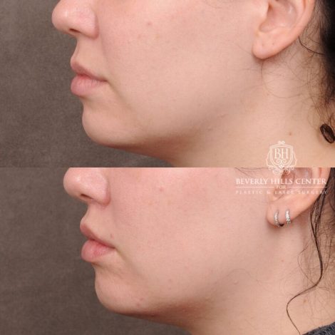 Beverly Hills Center Female Patient Before and After CUPID LIFT® Lip Lift