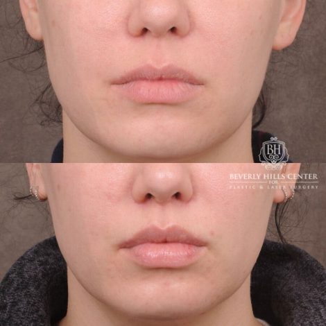 Beverly Hills Center Female Patient Before and After CUPID LIFT® Lip Lift