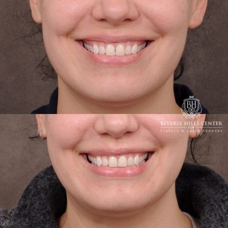 Beverly Hills Center Female Patient Before and After CUPID LIFT® Lip Lift