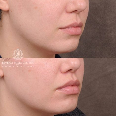 Beverly Hills Center Female Patient Before and After CUPID LIFT® Lip Lift