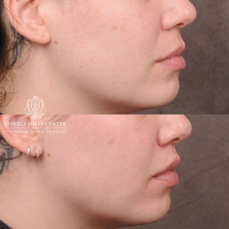Beverly Hills Center Female Patient Before and After CUPID LIFT® Lip Lift