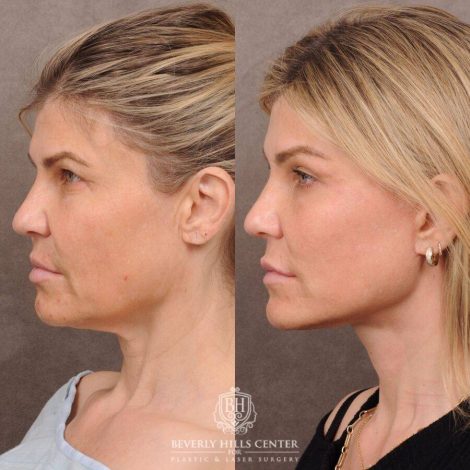 Beverly Hills Center Female Patient Before and After AuraLyft, Brow Lift, CUPID LIFT® Corner Lift