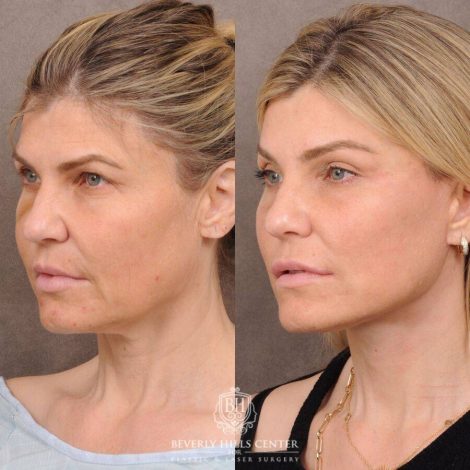 Beverly Hills Center Female Patient Before and After AuraLyft, Brow Lift, CUPID LIFT® Corner Lift