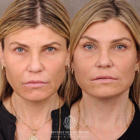 Beverly Hills Center Female Patient Before and After AuraLyft, Brow Lift, CUPID LIFT® Corner Lift