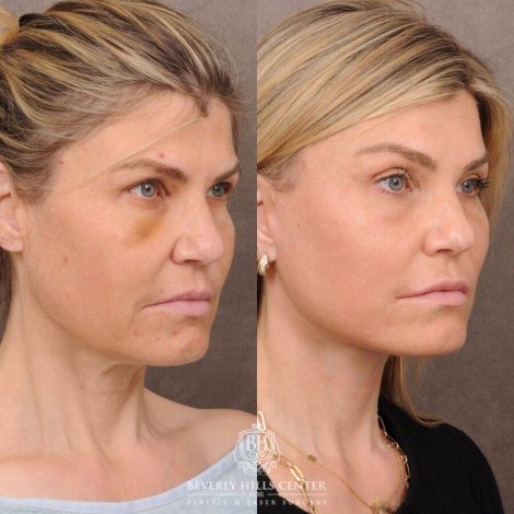 Beverly Hills Center Female Patient Before and After AuraLyft, Brow Lift, CUPID LIFT® Corner Lift