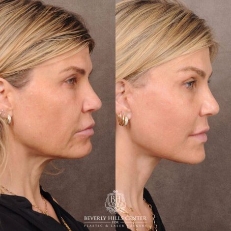 Beverly Hills Center Female Patient Before and After AuraLyft, Brow Lift, CUPID LIFT® Corner Lift