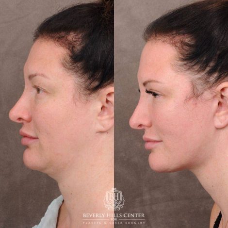 Beverly Hills Center Female Patient Before and After AuraLyft, Upper & Lower Blepharoplasty