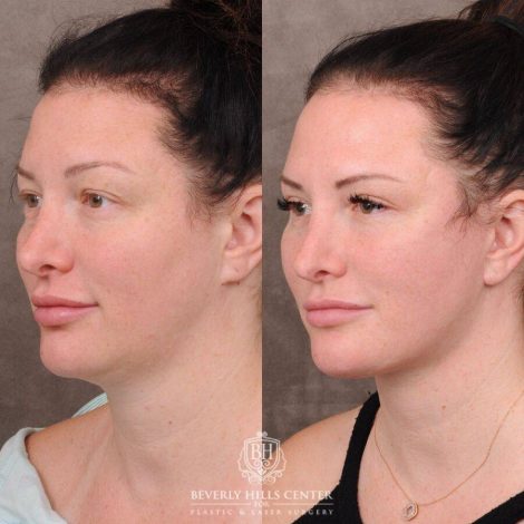 Beverly Hills Center Female Patient Before and After AuraLyft, Upper & Lower Blepharoplasty