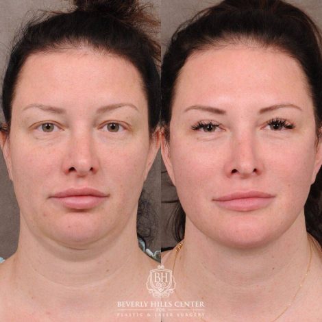 Beverly Hills Center Female Patient Before and After AuraLyft, Upper & Lower Blepharoplasty