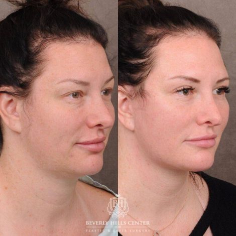 Beverly Hills Center Female Patient Before and After AuraLyft, Upper & Lower Blepharoplasty