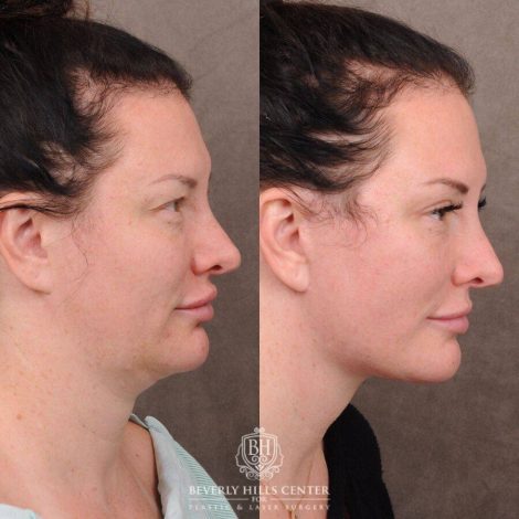 Beverly Hills Center Female Patient Before and After AuraLyft, Upper & Lower Blepharoplasty