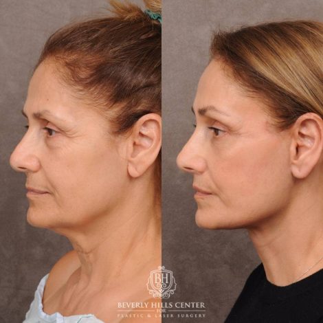 Beverly Hills Center Female Patient Before and After Comprehensive AuraLyft, Mini Brow Lift, CUPID LIFT® Lip Lift