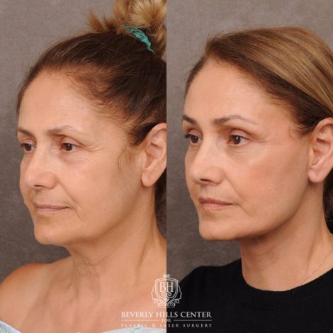 Beverly Hills Center Female Patient Before and After Comprehensive AuraLyft, Mini Brow Lift, CUPID LIFT® Lip Lift