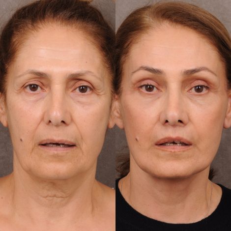 Beverly Hills Center Female Patient Before and After Comprehensive AuraLyft, Mini Brow Lift, CUPID LIFT® Lip Lift