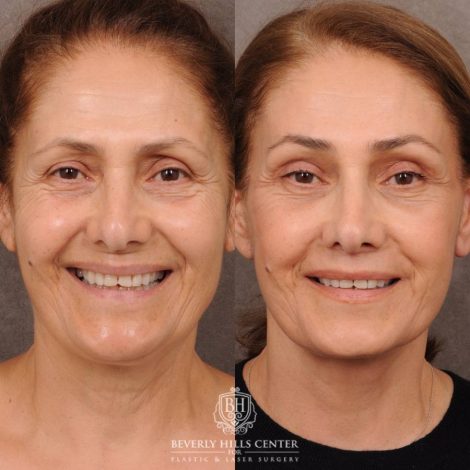 Beverly Hills Center Female Patient Before and After Comprehensive AuraLyft, Mini Brow Lift, CUPID LIFT® Lip Lift