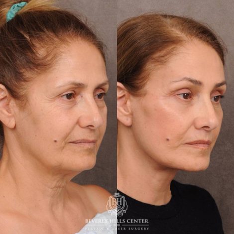 Beverly Hills Center Female Patient Before and After Comprehensive AuraLyft, Mini Brow Lift, CUPID LIFT® Lip Lift