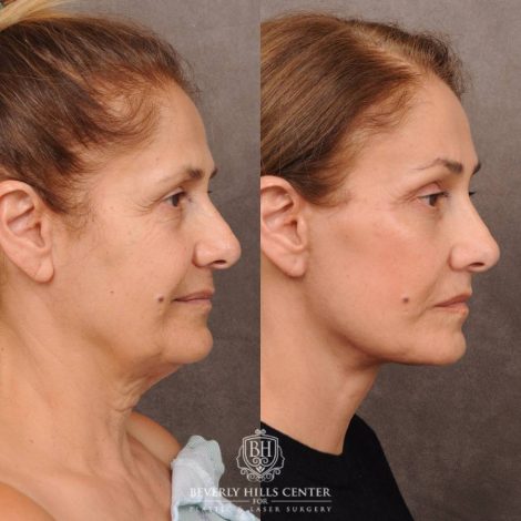 Beverly Hills Center Female Patient Before and After Comprehensive AuraLyft, Mini Brow Lift, CUPID LIFT® Lip Lift