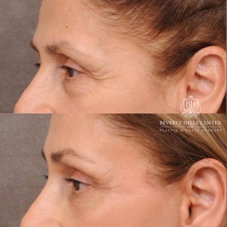 Beverly Hills Center Female Patient Before and After Comprehensive AuraLyft, Mini Brow Lift, CUPID LIFT® Lip Lift