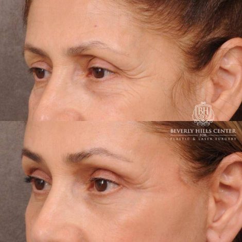 Beverly Hills Center Female Patient Before and After Comprehensive AuraLyft, Mini Brow Lift, CUPID LIFT® Lip Lift