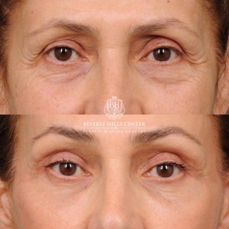 Beverly Hills Center Female Patient Before and After Comprehensive AuraLyft, Mini Brow Lift, CUPID LIFT® Lip Lift