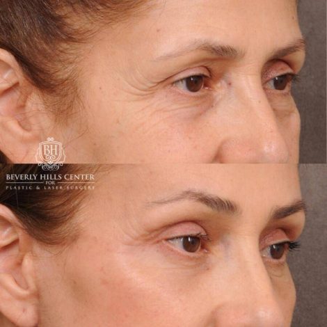 Beverly Hills Center Female Patient Before and After Comprehensive AuraLyft, Mini Brow Lift, CUPID LIFT® Lip Lift