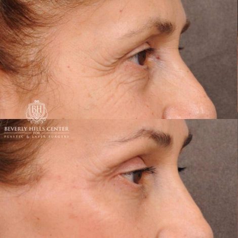 Beverly Hills Center Female Patient Before and After Comprehensive AuraLyft, Mini Brow Lift, CUPID LIFT® Lip Lift